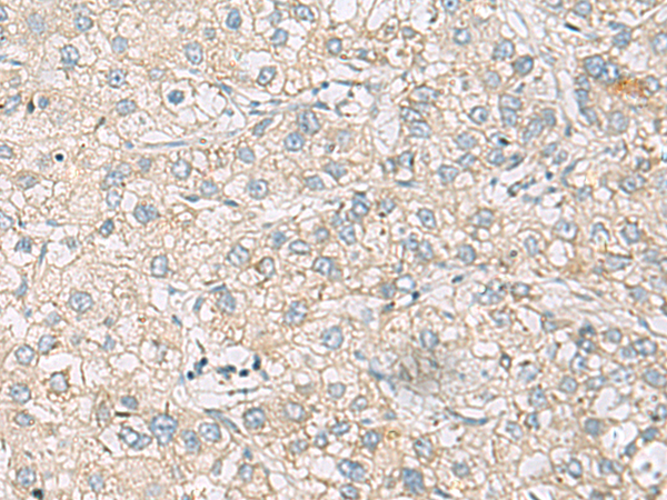 Immunohistochemistry of paraffin-embedded Human liver cancer tissue  using RAC2 Polyclonal Antibody at dilution of 1:60(×200)