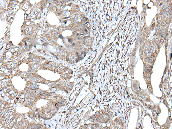 Immunohistochemistry of paraffin-embedded Human colorectal cancer tissue  using RAD54B Polyclonal Antibody at dilution of 1:45(×200)