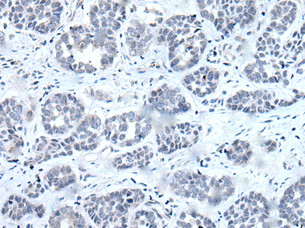 Immunohistochemistry of paraffin-embedded Human esophagus cancer tissue  using RARG Polyclonal Antibody at dilution of 1:55(×200)