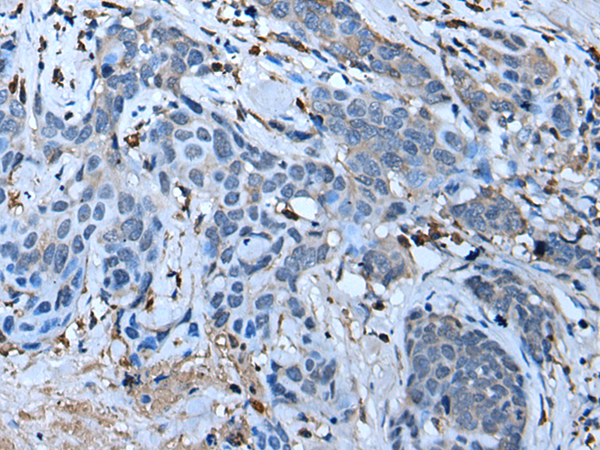 Immunohistochemistry of paraffin-embedded Human thyroid cancer tissue  using F3 Polyclonal Antibody at dilution of 1:70(×200)