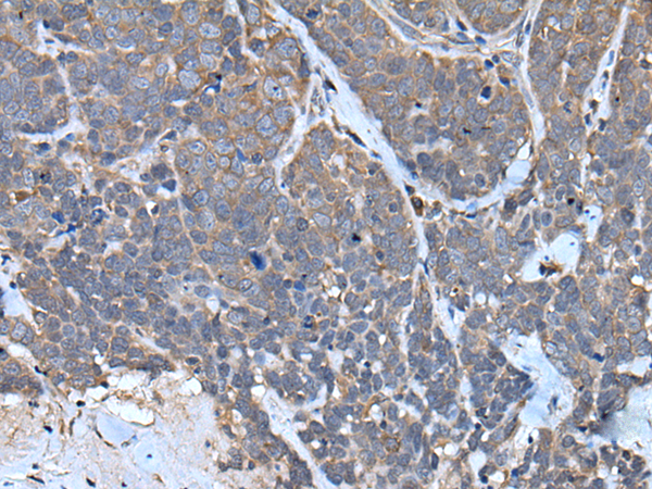 Immunohistochemistry of paraffin-embedded Human thyroid cancer tissue  using TNMD Polyclonal Antibody at dilution of 1:40(×200)