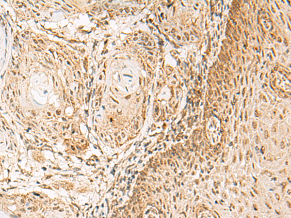 Immunohistochemistry of paraffin-embedded Human esophagus cancer tissue  using HNF1A Polyclonal Antibody at dilution of 1:30(×200)