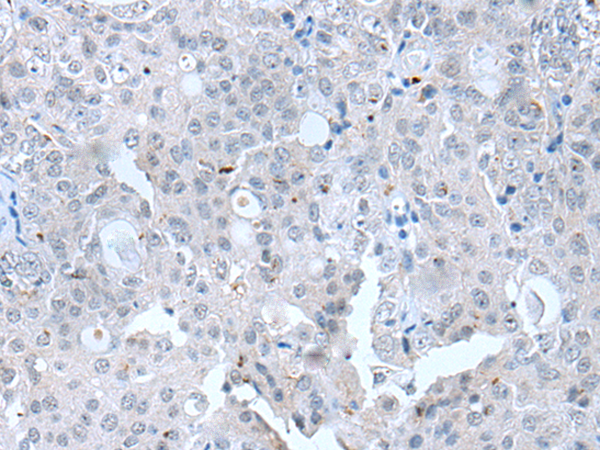 Immunohistochemistry of paraffin-embedded Human ovarian cancer tissue  using CLDN12 Polyclonal Antibody at dilution of 1:45(×200)