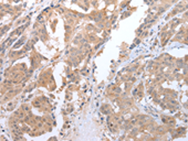 Immunohistochemistry of paraffin-embedded Human breast cancer tissue  using ATG16L1 Polyclonal Antibody at dilution of 1:45(×200)