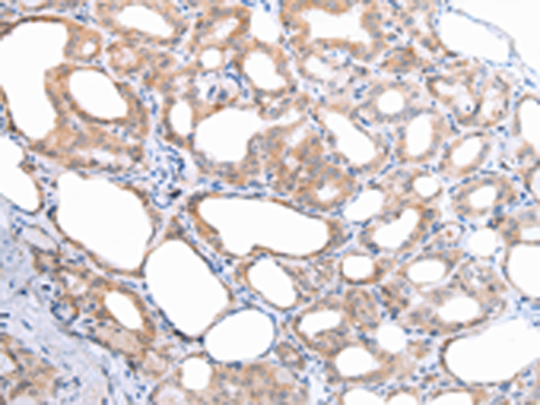 Immunohistochemistry of paraffin-embedded Human thyroid cancer tissue  using ATG16L1 Polyclonal Antibody at dilution of 1:45(×200)