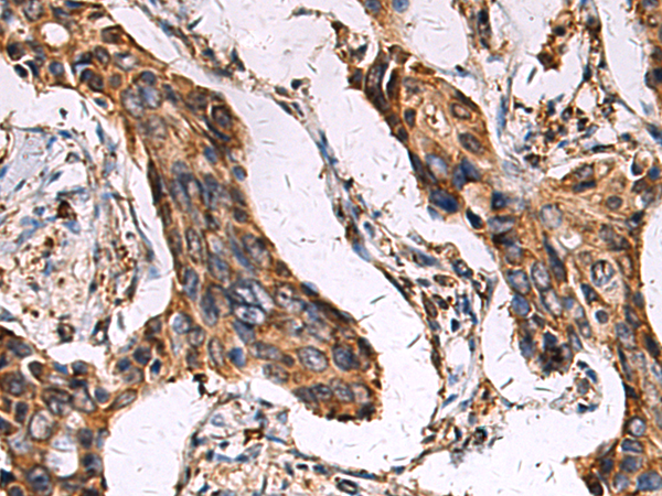 Immunohistochemistry of paraffin-embedded Human breast cancer tissue  using ECM1 Polyclonal Antibody at dilution of 1:45(×200)
