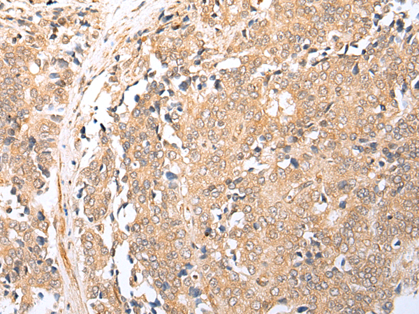 Immunohistochemistry of paraffin-embedded Human prost at e cancer tissue  using BAG2 Polyclonal Antibody at dilution of 1:25(×200)