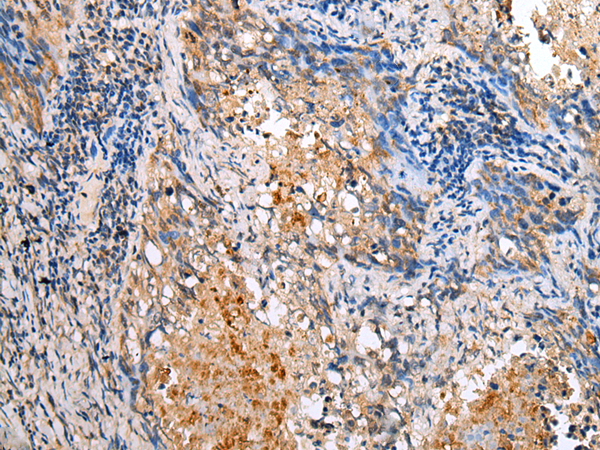 Immunohistochemistry of paraffin-embedded Human lung cancer tissue  using BAG2 Polyclonal Antibody at dilution of 1:25(×200)