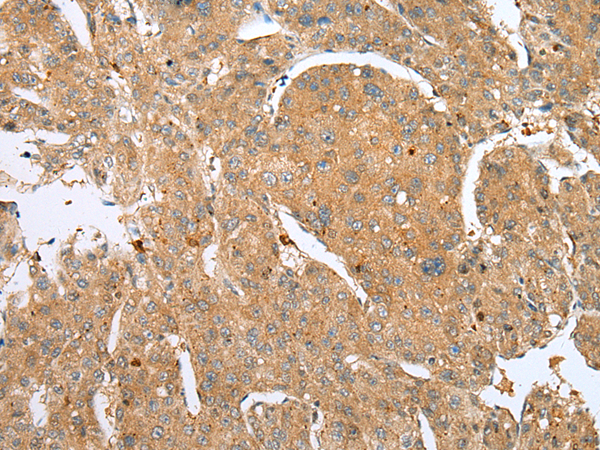 Immunohistochemistry of paraffin-embedded Human liver cancer tissue  using DCX Polyclonal Antibody at dilution of 1:30(×200)