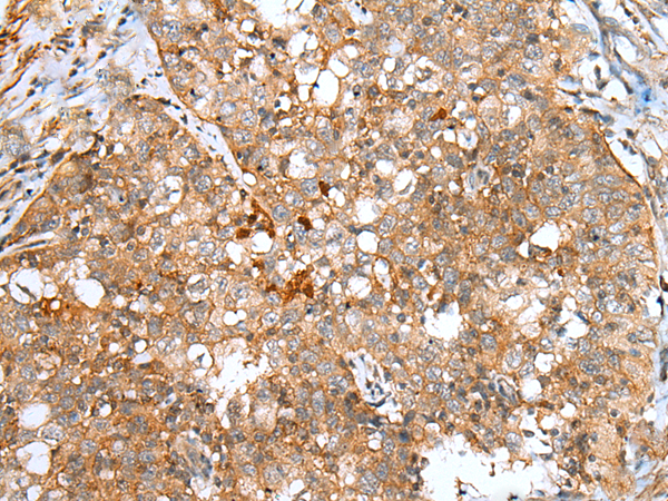 Immunohistochemistry of paraffin-embedded Human esophagus cancer tissue  using DCX Polyclonal Antibody at dilution of 1:30(×200)