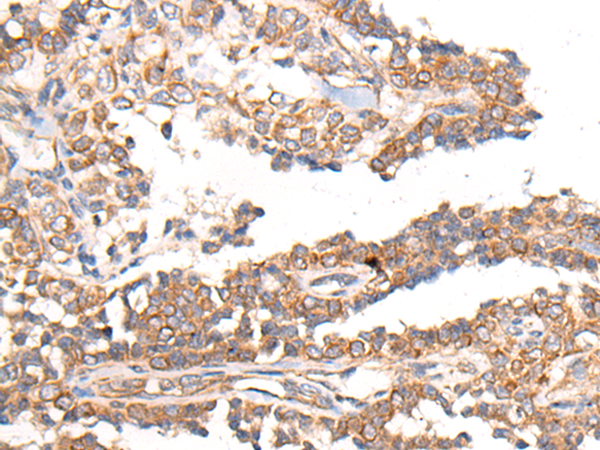 Immunohistochemistry of paraffin-embedded Human ovarian cancer tissue  using MTNR1B Polyclonal Antibody at dilution of 1:55(×200)