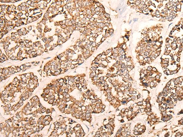 Immunohistochemistry of paraffin-embedded Human esophagus cancer tissue  using GRIA4 Polyclonal Antibody at dilution of 1:40(×200)