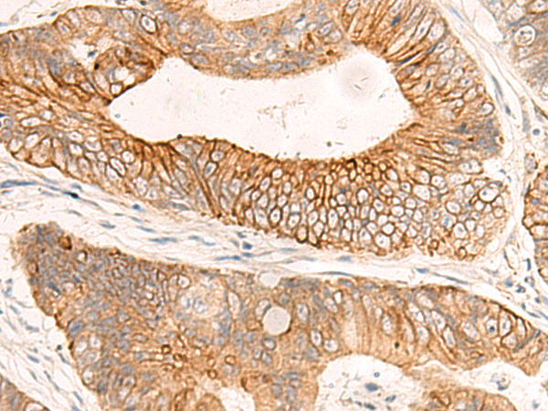 Immunohistochemistry of paraffin-embedded Human colorectal cancer tissue  using ABHD2 Polyclonal Antibody at dilution of 1:50(×200)