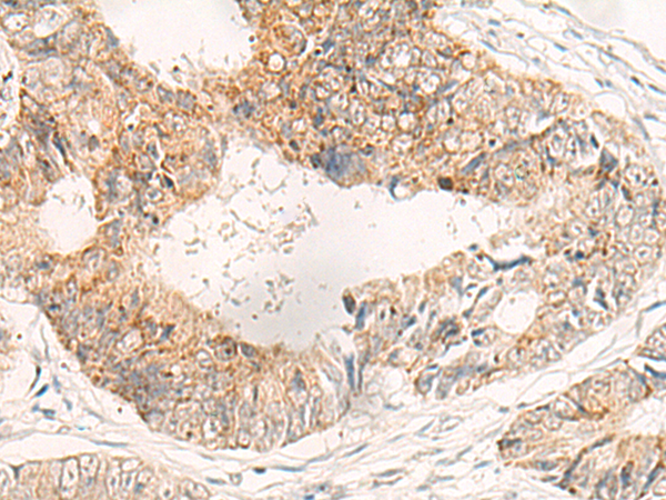 Immunohistochemistry of paraffin-embedded Human colorectal cancer tissue  using ADAMTS2 Polyclonal Antibody at dilution of 1:40(×200)