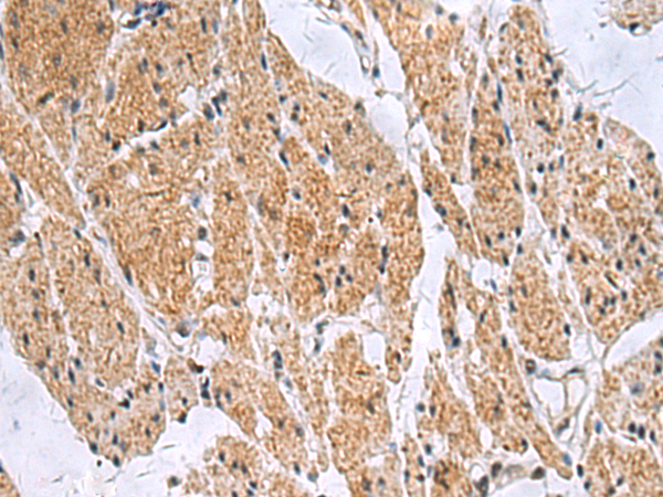 Immunohistochemistry of paraffin-embedded Human esophagus cancer tissue  using SLC4A3 Polyclonal Antibody at dilution of 1:35(×200)