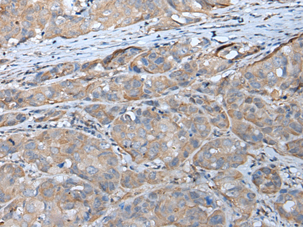 Immunohistochemistry of paraffin-embedded Human breast cancer tissue  using GPC5 Polyclonal Antibody at dilution of 1:40(×200)