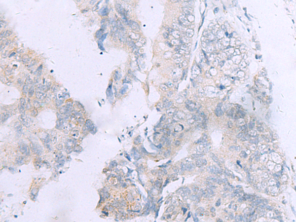 Immunohistochemistry of paraffin-embedded Human colorectal cancer tissue  using GPC3 Polyclonal Antibody at dilution of 1:60(×200)