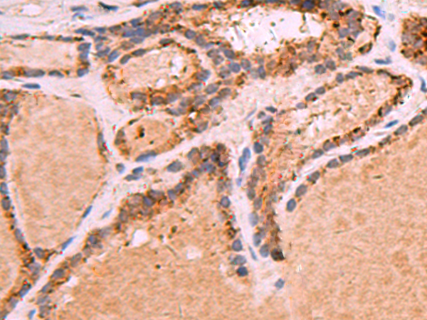 Immunohistochemistry of paraffin-embedded Human thyroid cancer tissue  using GPC2 Polyclonal Antibody at dilution of 1:35(×200)