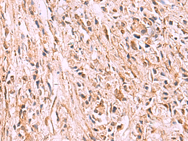 Immunohistochemistry of paraffin-embedded Human prost ate cancer tissue  using GPC2 Polyclonal Antibody at dilution of 1:35(×200)