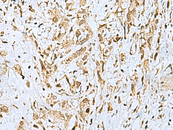 Immunohistochemistry of paraffin-embedded Human gastric cancer tissue  using HOXC9 Polyclonal Antibody at dilution of 1:110(×200)