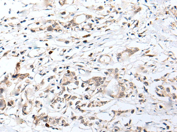 Immunohistochemistry of paraffin-embedded Human gastric cancer tissue  using CHRNA5 Polyclonal Antibody at dilution of 1:50(×200)