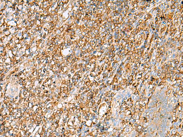 Immunohistochemistry of paraffin-embedded Human tonsil tissue  using LGALS9 Polyclonal Antibody at dilution of 1:30(×200)