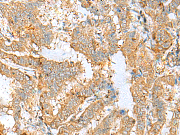 Immunohistochemistry of paraffin-embedded Human thyroid cancer tissue  using LGALS9 Polyclonal Antibody at dilution of 1:30(×200)