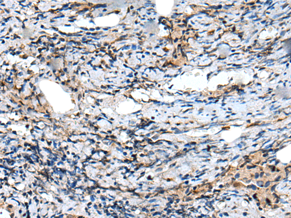 Immunohistochemistry of paraffin-embedded Human prost ate cancer tissue  using CXCL6 Polyclonal Antibody at dilution of 1:60(×200)