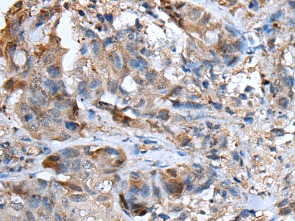 Immunohistochemistry of paraffin-embedded Human breast cancer tissue  using CXCL5 Polyclonal Antibody at dilution of 1:50(×200)