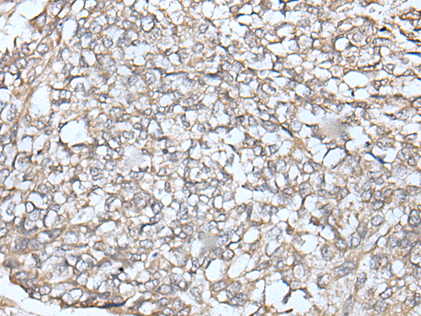 Immunohistochemistry of paraffin-embedded Human lung cancer tissue  using IFNB1 Polyclonal Antibody at dilution of 1:45(×200)