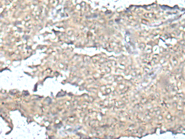 Immunohistochemistry of paraffin-embedded Human ovarian cancer tissue  using MEF2D Polyclonal Antibody at dilution of 1:50(×200)