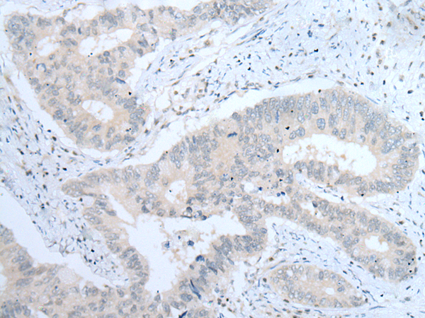 Immunohistochemistry of paraffin-embedded Human colorectal cancer tissue  using ITGA8 Polyclonal Antibody at dilution of 1:30(×200)