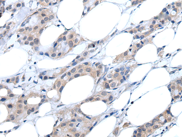 Immunohistochemistry of paraffin-embedded Human breast cancer tissue  using ANGPTL6 Polyclonal Antibody at dilution of 1:55(×200)