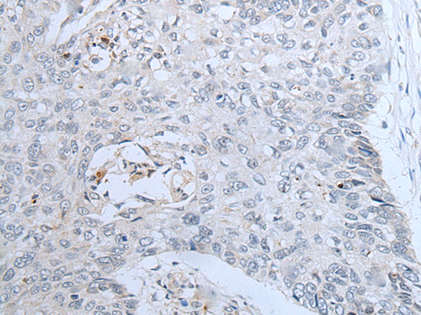 Immunohistochemistry of paraffin-embedded Human lung cancer tissue  using CENPF Polyclonal Antibody at dilution of 1:60(×200)