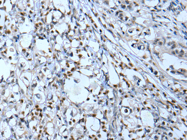 Immunohistochemistry of paraffin-embedded Human gastric cancer tissue  using NF1 Polyclonal Antibody at dilution of 1:65(×200)