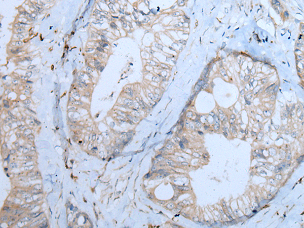 Immunohistochemistry of paraffin-embedded Human colorectal cancer tissue  using CNTN1 Polyclonal Antibody at dilution of 1:55(×200)