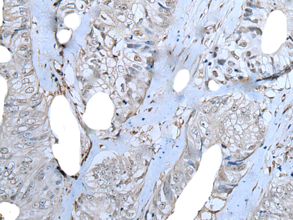 Immunohistochemistry of paraffin-embedded Human colorectal cancer tissue  using ZNF703 Polyclonal Antibody at dilution of 1:40(×200)