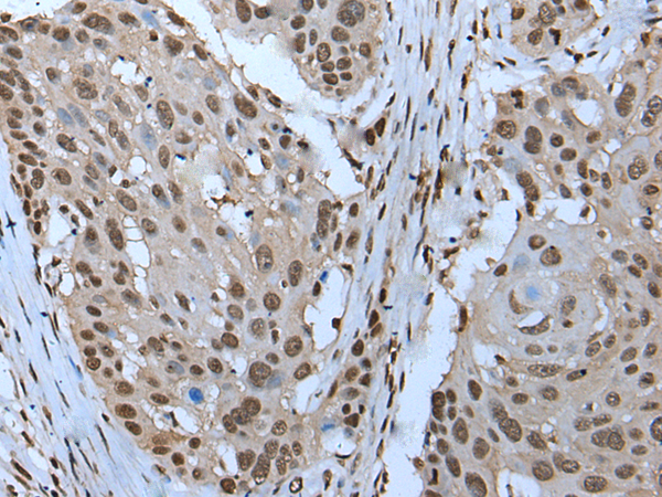 Immunohistochemistry of paraffin-embedded Human esophagus cancer tissue  using ZNHIT3 Polyclonal Antibody at dilution of 1:95(×200)