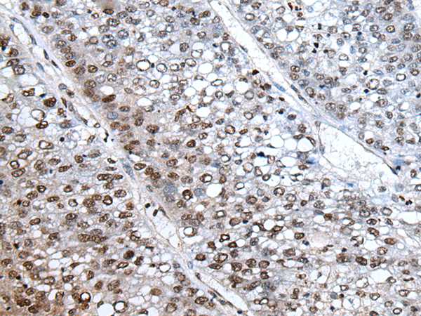 Immunohistochemistry of paraffin-embedded Human liver cancer tissue  using HIST1H3A Polyclonal Antibody at dilution of 1:30(×200)