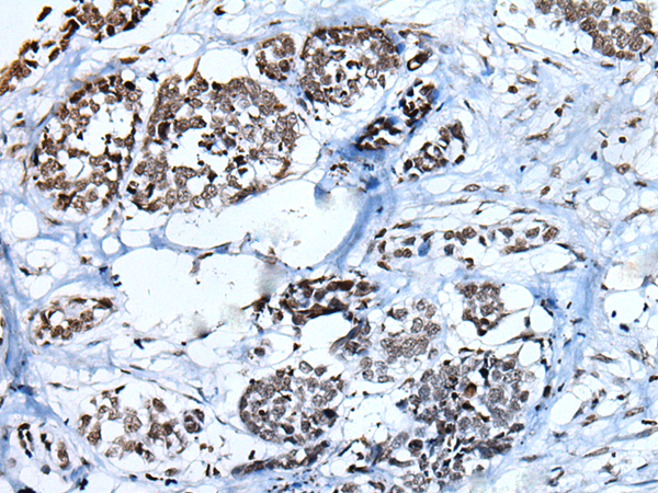 Immunohistochemistry of paraffin-embedded Human esophagus cancer tissue  using HIST1H3A Polyclonal Antibody at dilution of 1:30(×200)