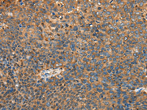 Immunohistochemistry of paraffin-embedded Human cervical cancer tissue  using MYL12B Polyclonal Antibody at dilution of 1:25(×200)