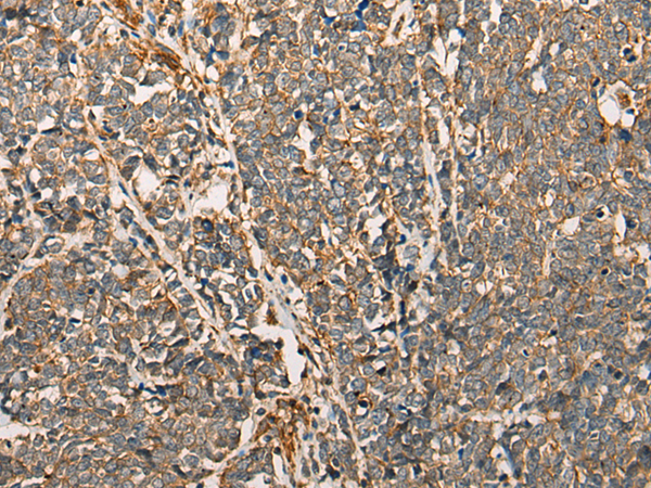 Immunohistochemistry of paraffin-embedded Human lung cancer tissue  using MYL12B Polyclonal Antibody at dilution of 1:25(×200)