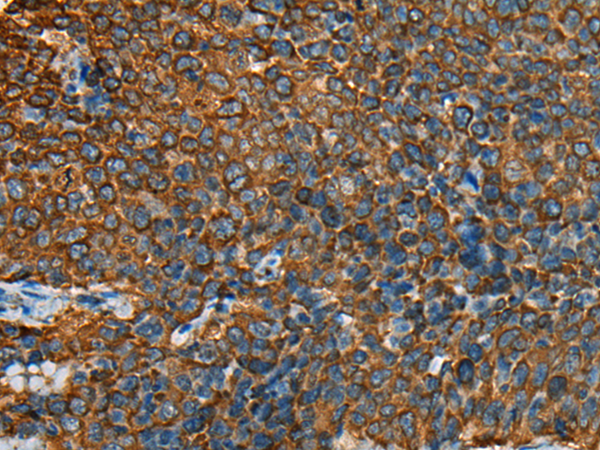 Immunohistochemistry of paraffin-embedded Human cervical cancer tissue  using YBX1 Polyclonal Antibody at dilution of 1:25(×200)