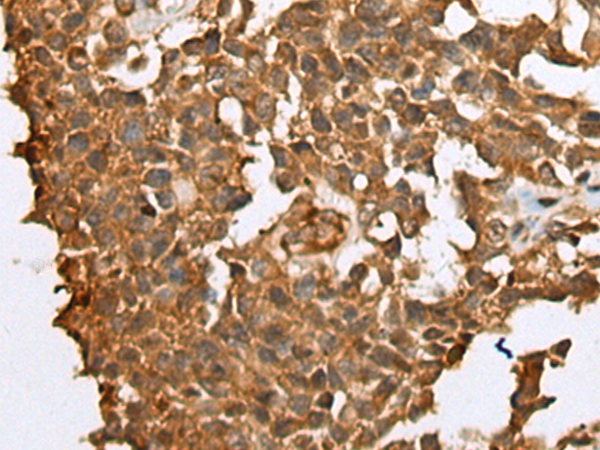 Immunohistochemistry of paraffin-embedded Human ovarian cancer tissue  using YBX1 Polyclonal Antibody at dilution of 1:25(×200)
