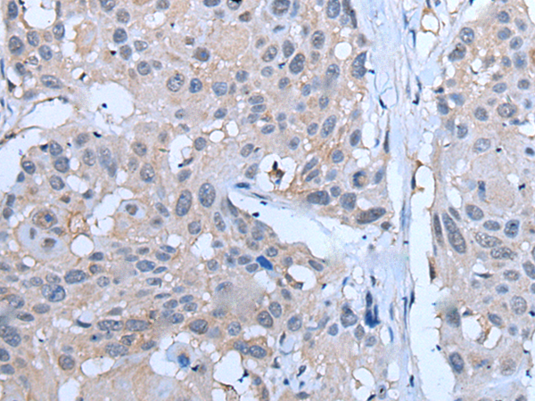 Immunohistochemistry of paraffin-embedded Human esophagus cancer tissue  using YPEL5 Polyclonal Antibody at dilution of 1:60(×200)