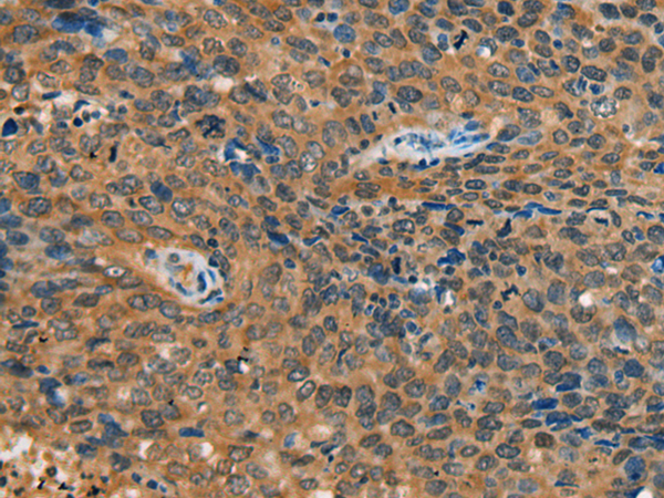 Immunohistochemistry of paraffin-embedded Human cervical cancer tissue  using YTHDF1 Polyclonal Antibody at dilution of 1:55(×200)