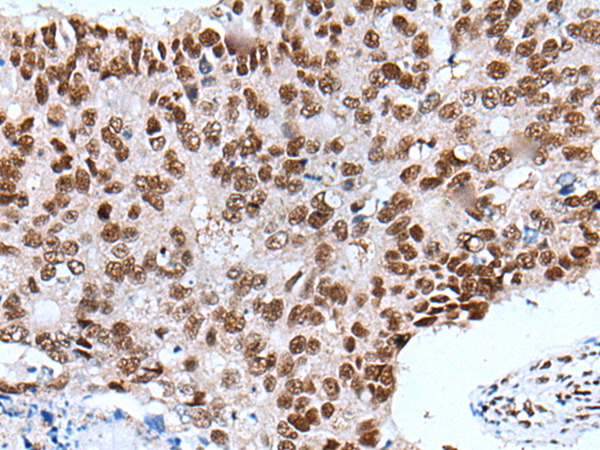 Immunohistochemistry of paraffin-embedded Human colorectal cancer tissue  using XAB2 Polyclonal Antibody at dilution of 1:25(×200)