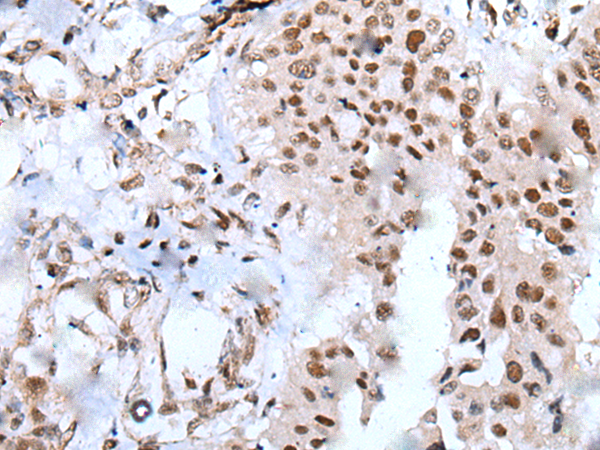 Immunohistochemistry of paraffin-embedded Human liver cancer tissue  using XAB2 Polyclonal Antibody at dilution of 1:25(×200)