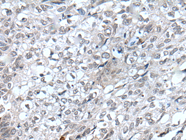 Immunohistochemistry of paraffin-embedded Human lung cancer tissue  using FLT4 Polyclonal Antibody at dilution of 1:40(×200)