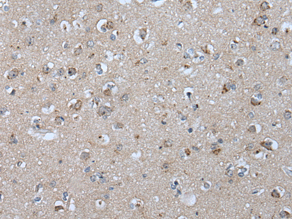 Immunohistochemistry of paraffin-embedded Human brain tissue  using VPS35 Polyclonal Antibody at dilution of 1:25(×200)